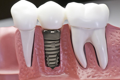 trồng răng implant giá bao nhiêu tiền