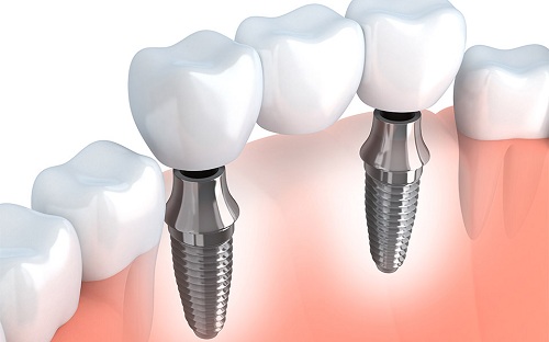Trồng răng implant là gì 3