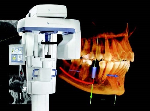 cấy ghép răng bằng phương pháp implant