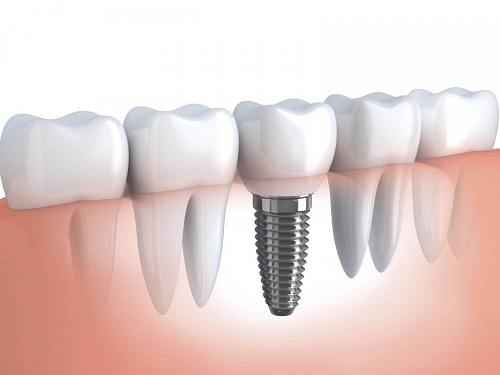 ghép răng implant ở đâu an toàn