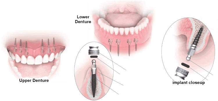 Trồng răng implant mất bao lâu 