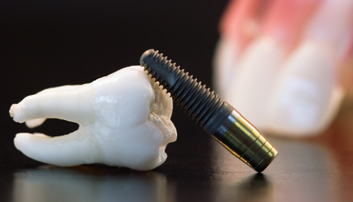 công nghệ cắm ghép răng implant
