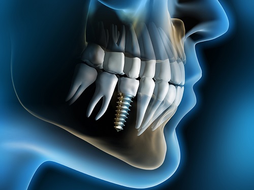 giá cả trồng răng implant
