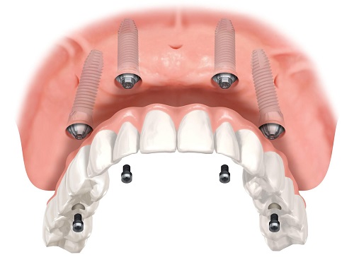 ưu điểm của cấy ghép răng implant 6