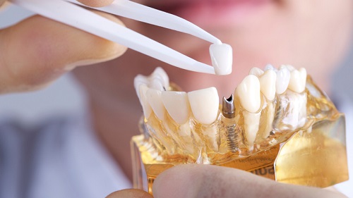 kinh nghiệm trồng răng implant