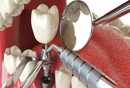 phương pháp trồng răng implant 