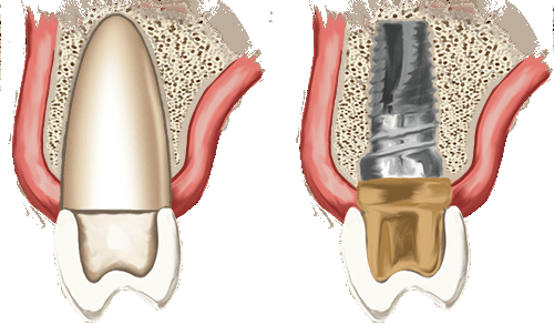 Image result for phuong phap trong implant