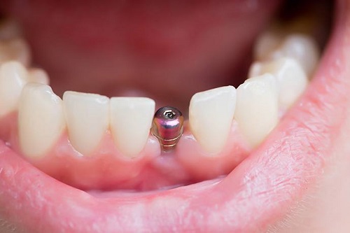 trồng răng bằng phương pháp implant có đau không