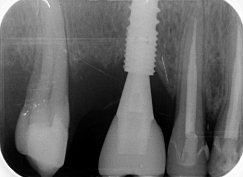cắm implant sau nhổ răng có được không 2