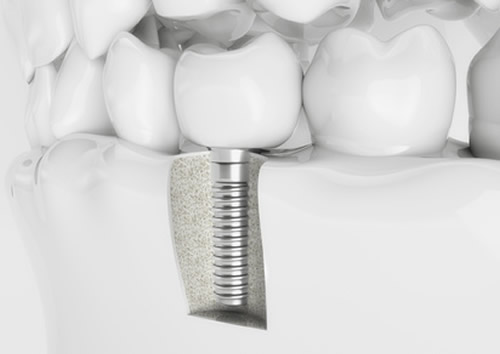 cấy ghép răng implant có bền không