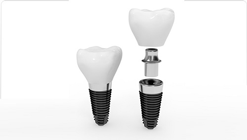 giá trồng răng giả implant