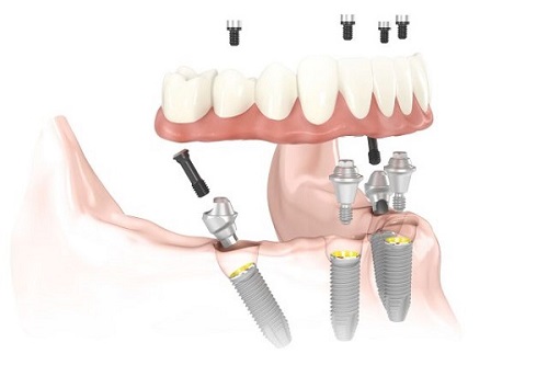 phục hình răng implant