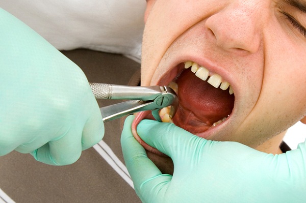 Nhổ răng hàm bị sâu 