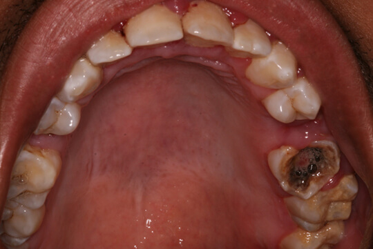 Nhổ răng hàm bị sâu