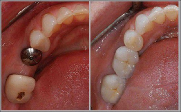 Nhổ răng hàm có đau không 3