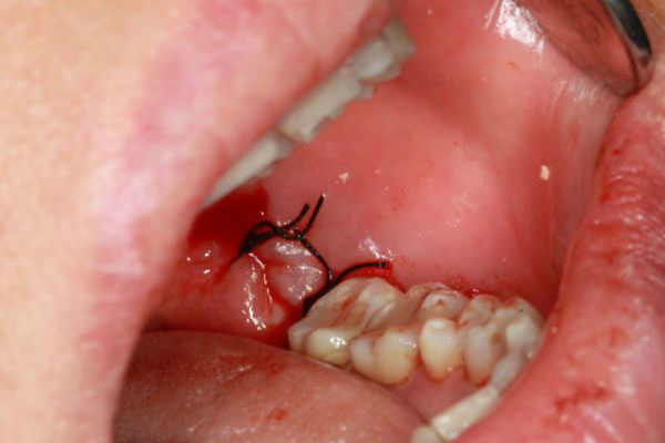 Nhổ răng bị chảy máu 