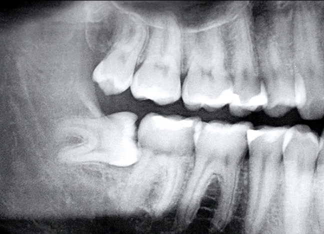 nhổ răng số 8 mọc lệch có nguy hiểm không