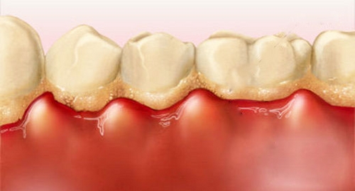 răng sâu bị lung lay 2