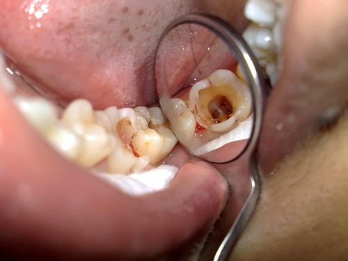 răng sâu bị lung lay