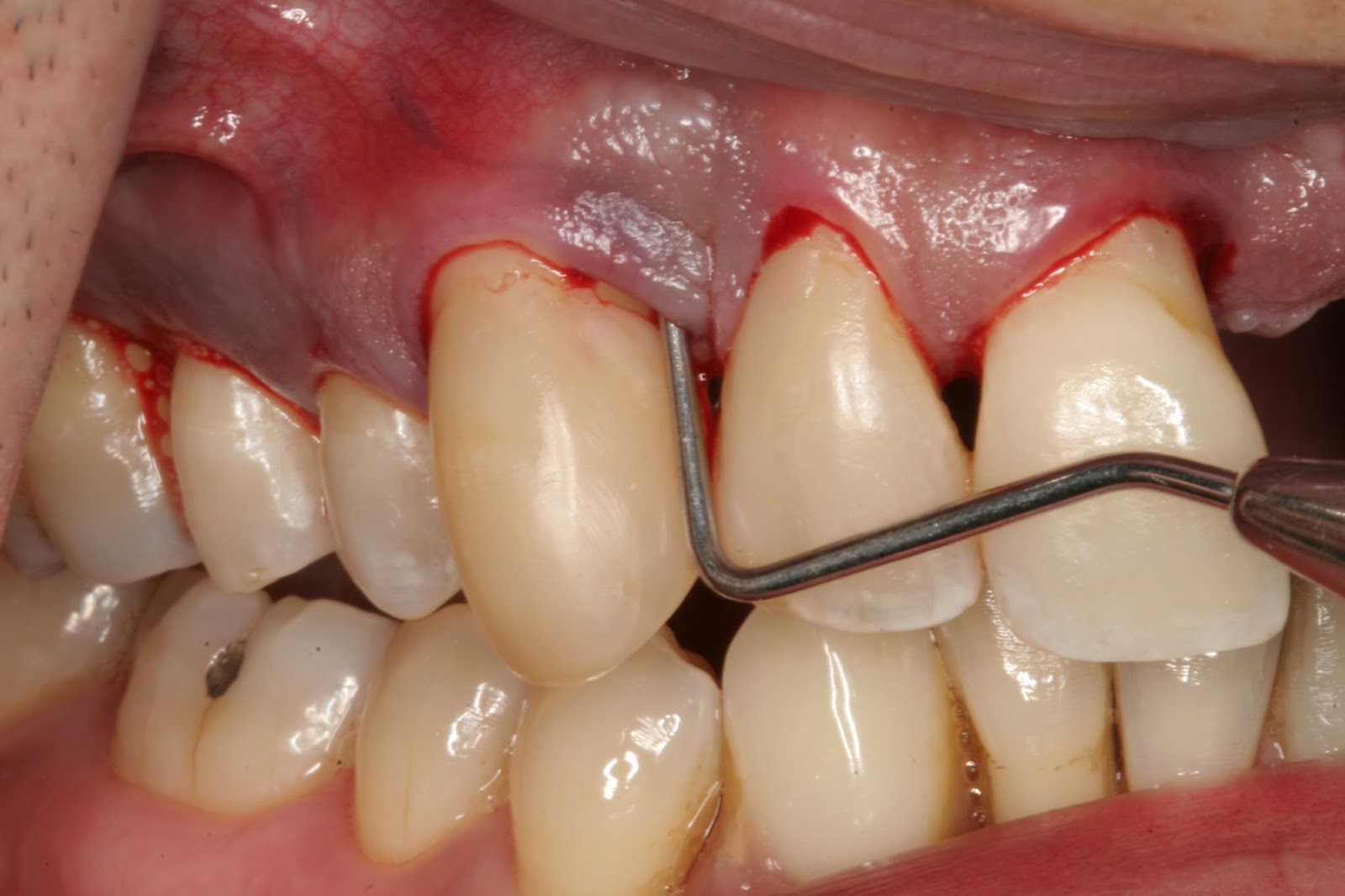 răng cấm bị lung lay
