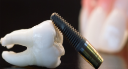 Có nên trồng răng implant- giải pháp phục hình răng không thể bỏ qua.