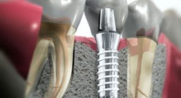 Cấy ghép răng implant giá bao nhiêu? [Cập nhật bảng giá chuẩn]