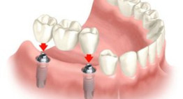 Kỹ thuật cấy ghép răng implant chuẩn quy trình là như thế nào?