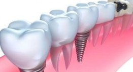 Người mất răng tìm đến với kỹ thuật cắm ghép răng implant hiện đại
