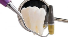 Tư vấn, giải đáp thắc mắc: Cấy ghép răng implant có ảnh hưởng gì không?