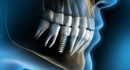 Nha khoa Dencos Luxury: Giá cả trồng răng implant đi đôi với chất lượng