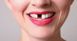 Làm lại răng cửa không thể bỏ qua phương pháp trồng răng implant.