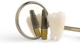 Giá trồng răng sứ vĩnh viễn có phù hợp với những lợi ích mà nó mang lại?