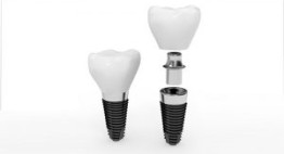 Phân chia giá trồng răng giả implant công nghệ OP300 theo từng loại