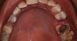 Nhổ răng hàm bị sâu – Phương pháp & những lưu ý quan trọng