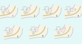 Liệu bạn đã biết: Có nên nhổ răng số 8 không?