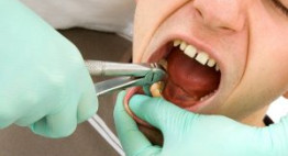 Bạn nên biết nhổ răng có nguy hiểm không trước khi thực hiện dịch vụ