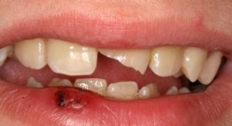 Phục hồi răng cửa bị mẻ bằng cách nào hiệu quả nhất hiện nay?