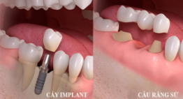 Nên làm câu răng hay implant ? – Giải đáp chi tiết của chuyên gia